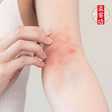 你有惱人的濕疹問題嗎（上）